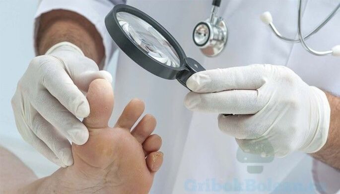 pėdų grybelio diagnozę nustato gydytojas