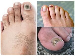 Grybelinės kojų nagų infekcijos požymiai