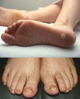 Mikozės apraiškos ant kojų odos ir nagų