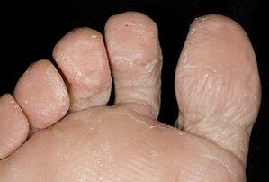 Pėdų oda su grybeline infekcija