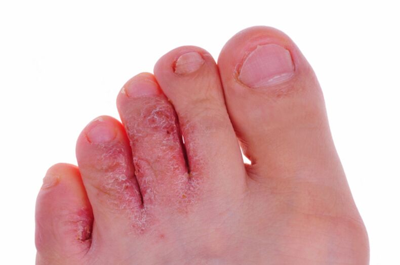 Rubrofitozės simptomai – įtrūkimai ir pleiskanos ant kojų odos