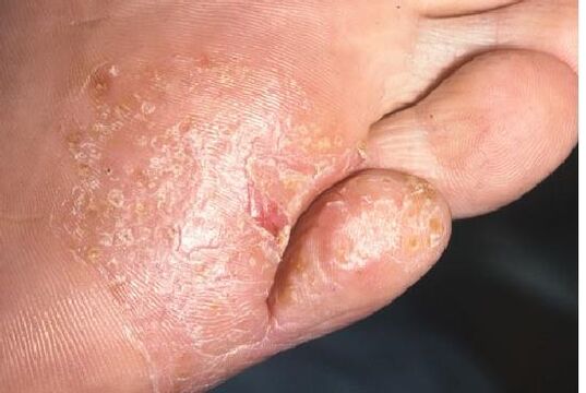Grybelinės infekcijos apraiškos ant pėdos odos