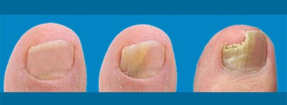 Onichomikozės - kojų nagų grybelio - vystymasis